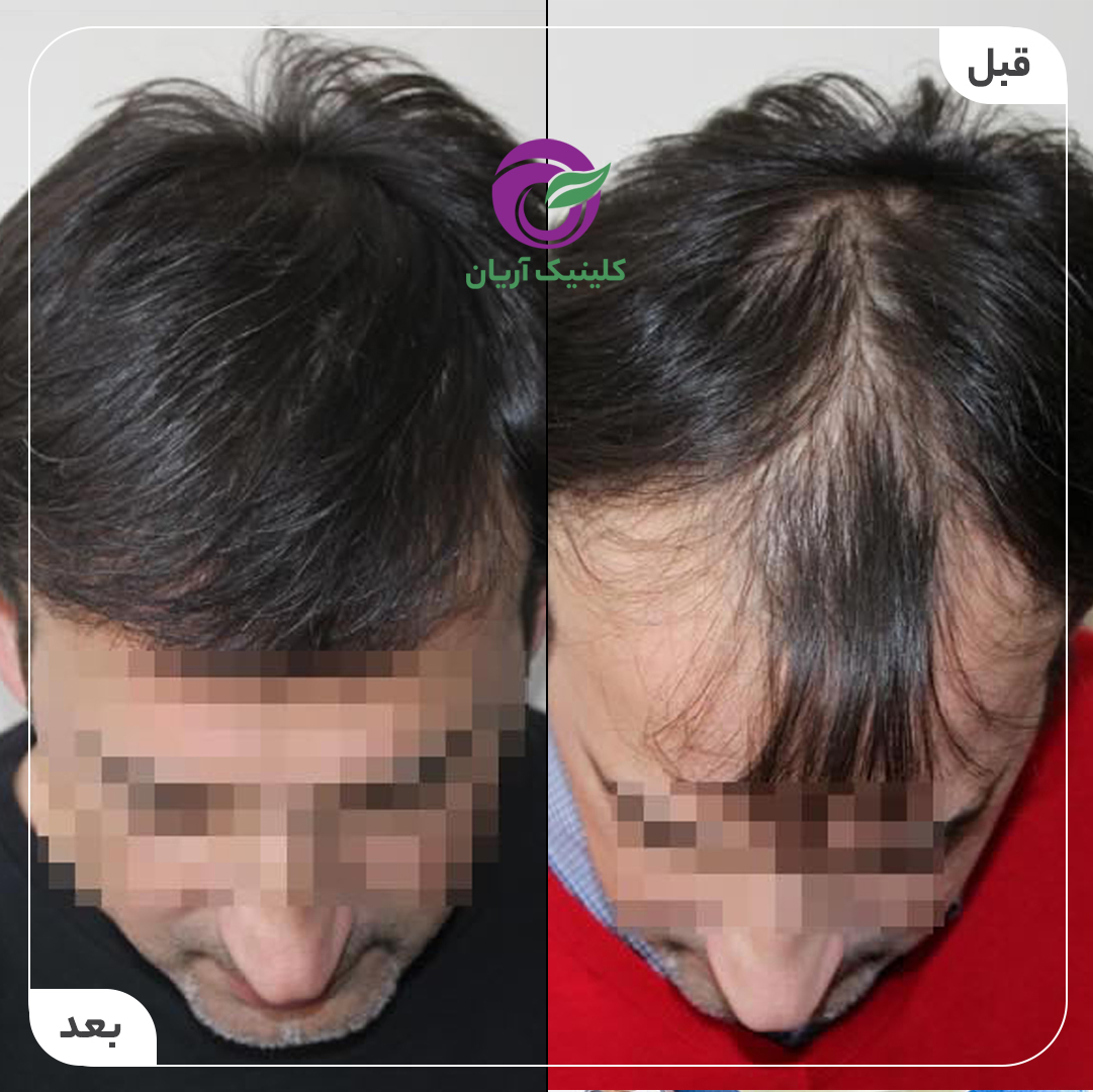 گالری کاشت مو 